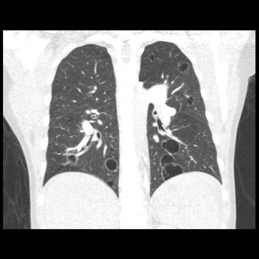 CXR and CT Chest