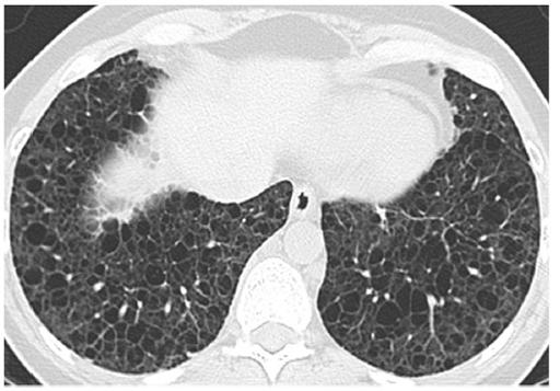 Lymphangioleiomyomatosis